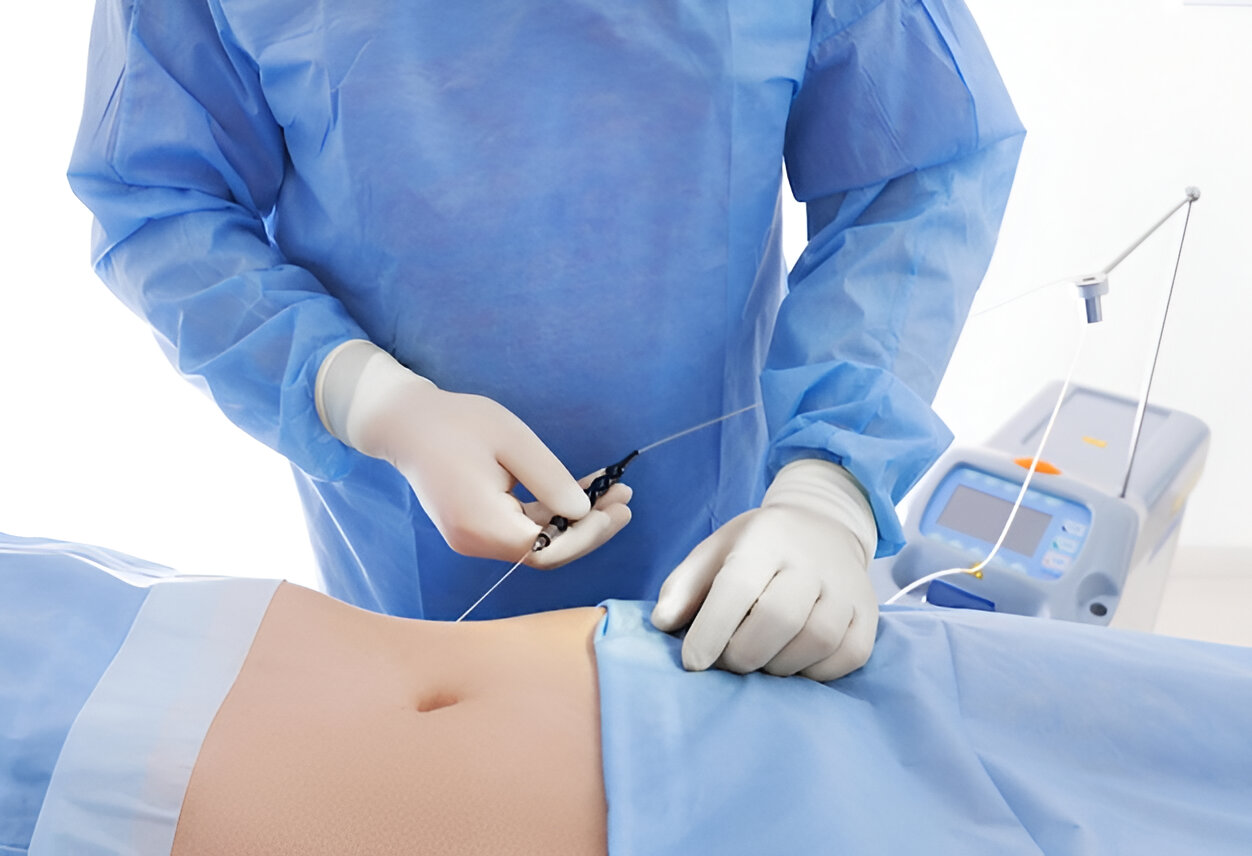 Abdominal Surgery